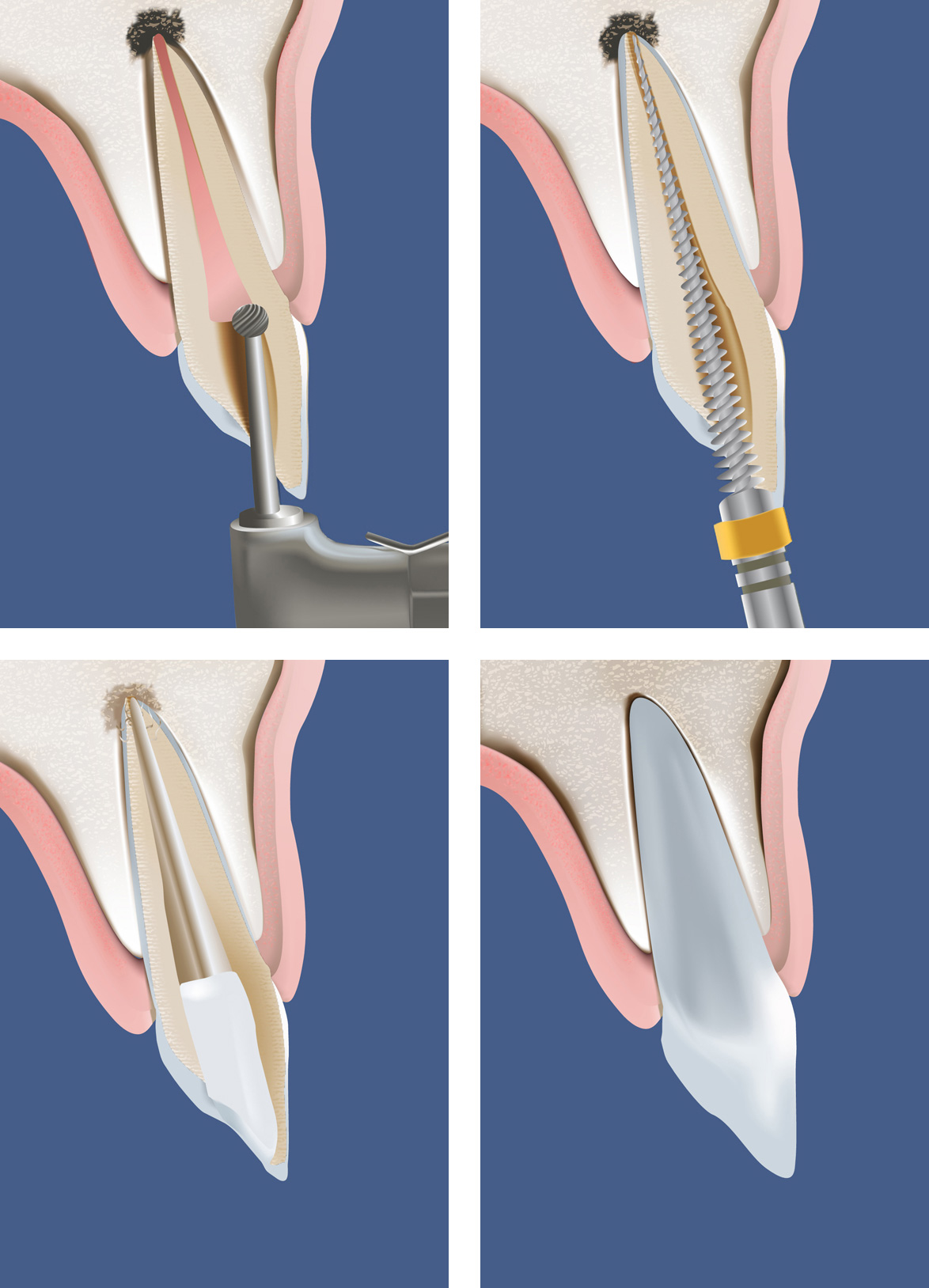 endodontische-revision
